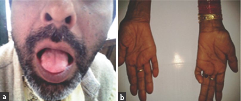 (a and b) Bulbar onset motor neuron disease showing spastic tongue, second patient showing atrophy of small muscles of hand.