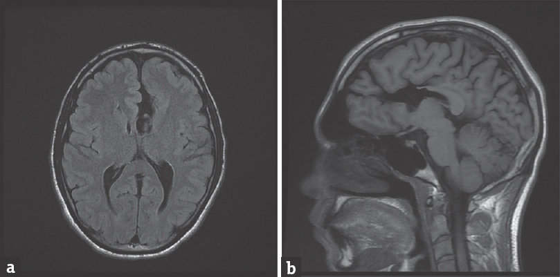 (a) An axial T1-weighted image demonstrates left frontal lobe open-lip schizencephaly. (b) A sagittal T1-weighted image (to the left of the midline) demonstrates a cerebrospinal fluid-filled cleft. Agenesis of the anterior part of the corpus callosum is also noted