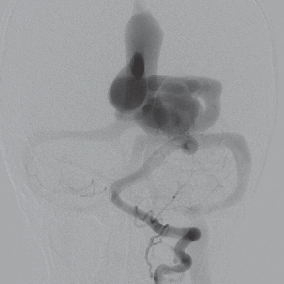 A cerebral angiography revealed evidence of an arteriovenous communication between posterior cerebral artery and distal anterior cerebral artery that drained to the sagittal sinus