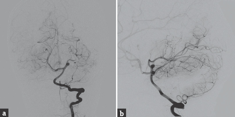 (a and b) A control cerebral angiography showed the complete occlusion of the fistula