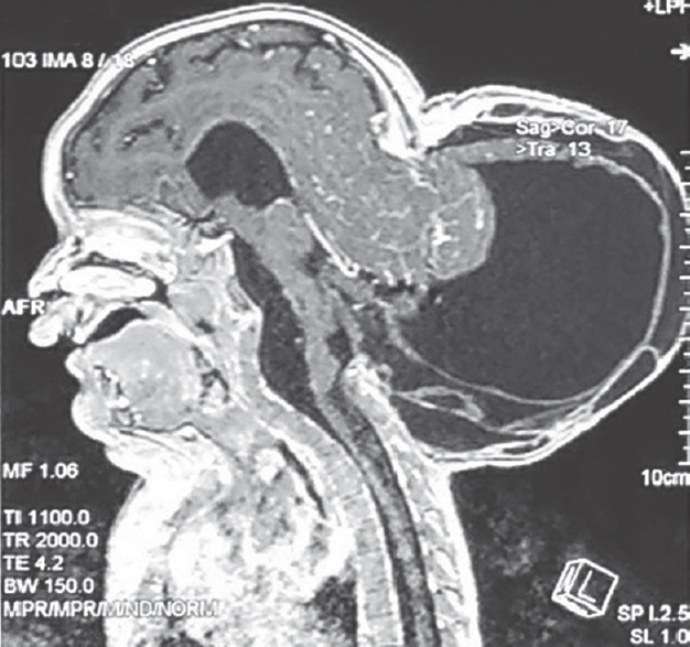 Sagittal magnetic resonance imaging sequence showing giant occipitocervical encephalocele sac with defects noted in the subtorcular region in occipital bone