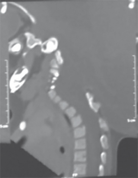 Sagittal computed tomography image at craniovertebral junction, absence of posterior elements in first four cervical vertebrae is appreciated