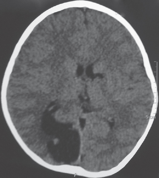 Computed tomography showing 2.1 cm × 2.8 cm × 2.7 cm sized cystic lesion in the right occipital lobe with small nodule