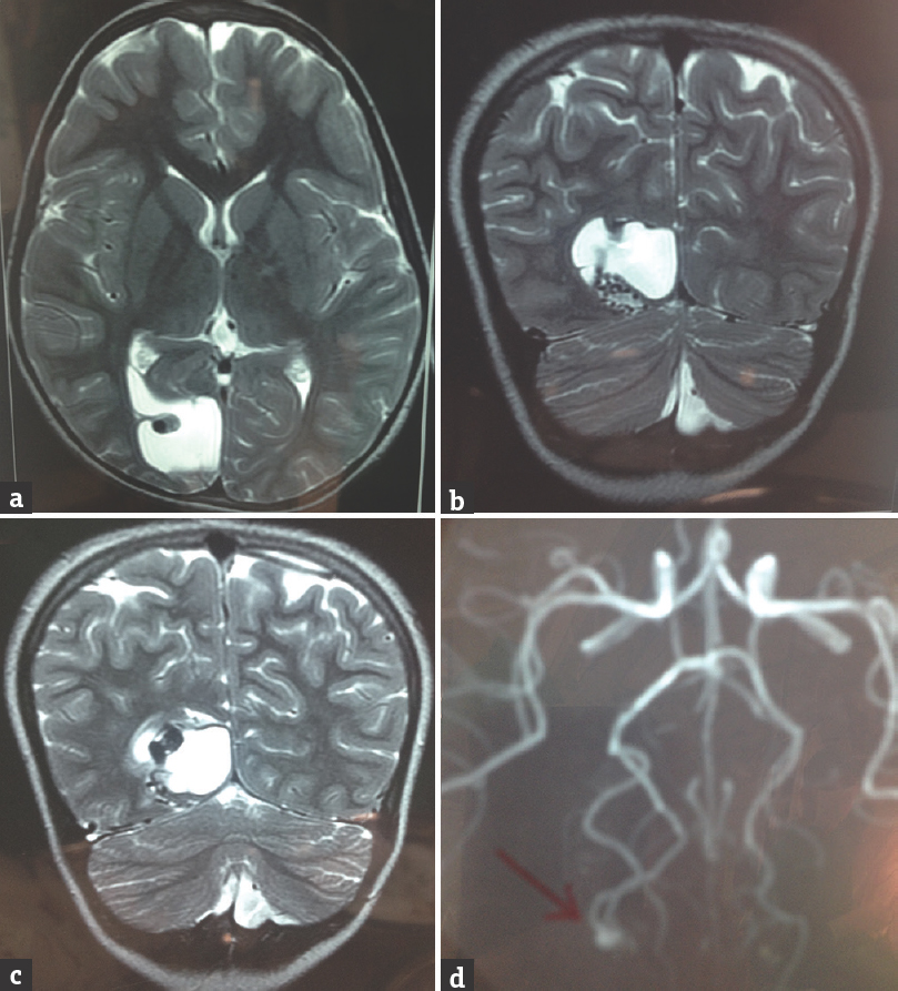 Magnetic resonance imaging showed well-defined predominantly cystic appearing lesion in right occipital lobe which was homogenous hyperintense on T2-weighted images axial view (a) and coronal view (b and c). It revealed small eccentric hypointense mural nodule along inferolateral lateral wall. Magnetic resonance angiography revealed cluster of abnormal serpiginous vessels along the inferior aspect of this lesion arising from right principal component analysis and were reaching up to eccentric nodule (d)