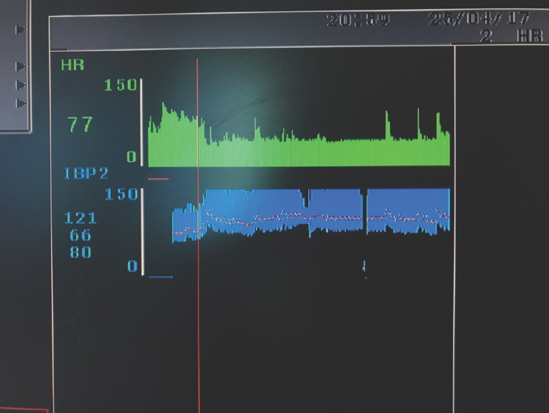 Red line denotes initiation of dexmedetomidine infusion at 0.5 μg/kg/h