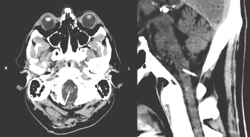 Noncontrast computed tomography brain showing axial (left) and sagittal (right) views of the needle as it penetrates the brainstem. The needle crosses the midline, with the tip located along the anterolateral aspect of the medulla to the left of the midline