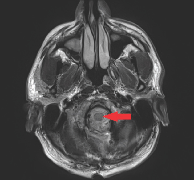 T2-weighted axial magnetic resonance imaging showing angled needle tract mark (tip of red arrow) through the left dorsal medulla. No evidence of surrounding inflammation, ischemia, or hemorrhage