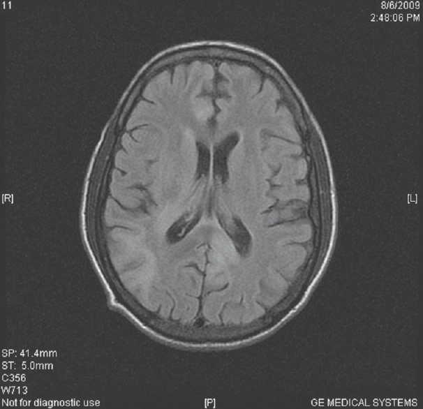 T2 fluid-attenuated inversion recovery images are showing small white matter hyperintensities in the right subcortical parietal region and in periventricular region