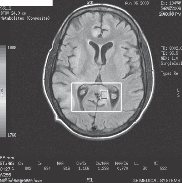 Magnetic resonance spectroscopy done in posterior periventricular lesion