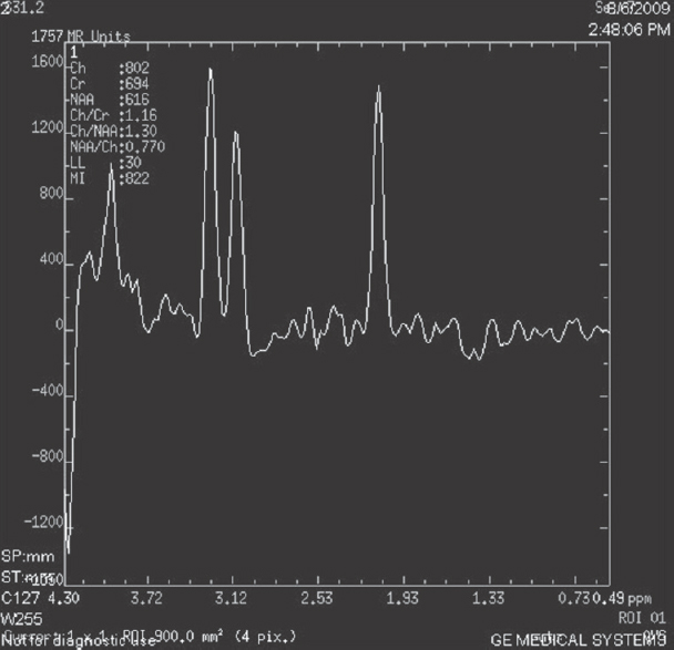 Magnetic resonance spectroscopy showed increase in choline peaks at that level