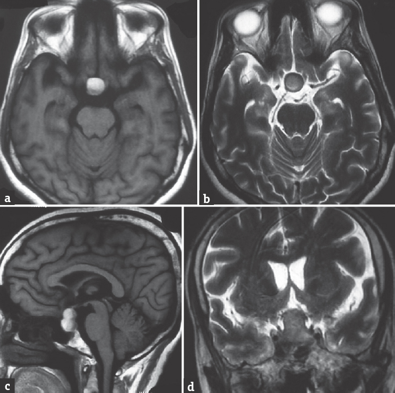 Axial magnetic resonance images showing (a) T1 hyperintense and (b) T2 isointense mass with a hypointense rim in the suprasellar region. Sagittal T1 image (c) showing the pituitary stalk is lifted up by the sellar-suprasellar mass with a fluid level inside and (d) coronal images showing the mass is reaching the optic chiasma