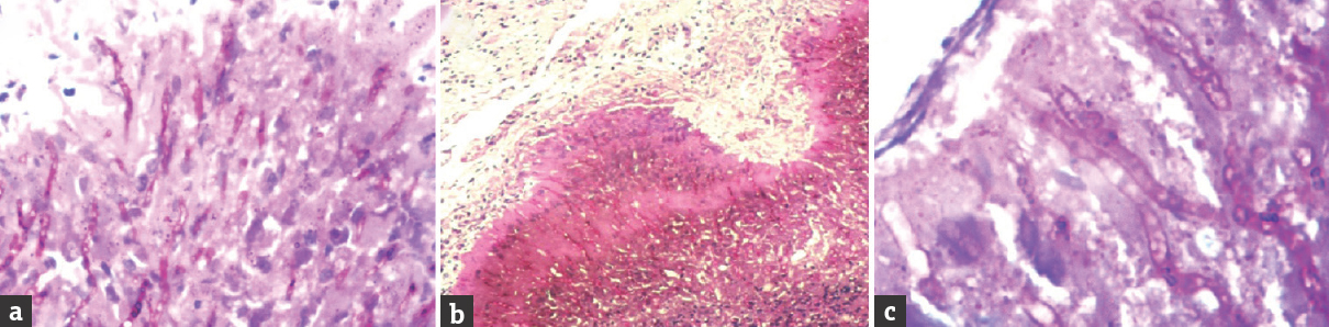 Histopathological images showing (a) periodic acid–Schiff-positive filamentous structures which are (b) radiating outward on an eosinophilic background. A magnified view (c) of the magenta-colored filamentous rods is shown