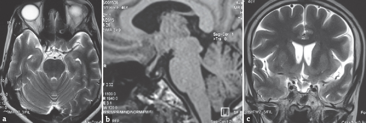 Postoperative magnetic resonance images (a) T2 axial, (b) T1 sagittal, and (c) T2 coronal showing no residual lesion. The hyperintense speck of the posterior pituitary is seen in the sagittal image inside the sella