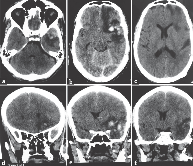 Axial (a-c) and coronal (d-f) computed tomography scan images of the brain revealing the left frontotemporal contusions with perilesional edema. Some mass effect is demonstrable but no midline shift