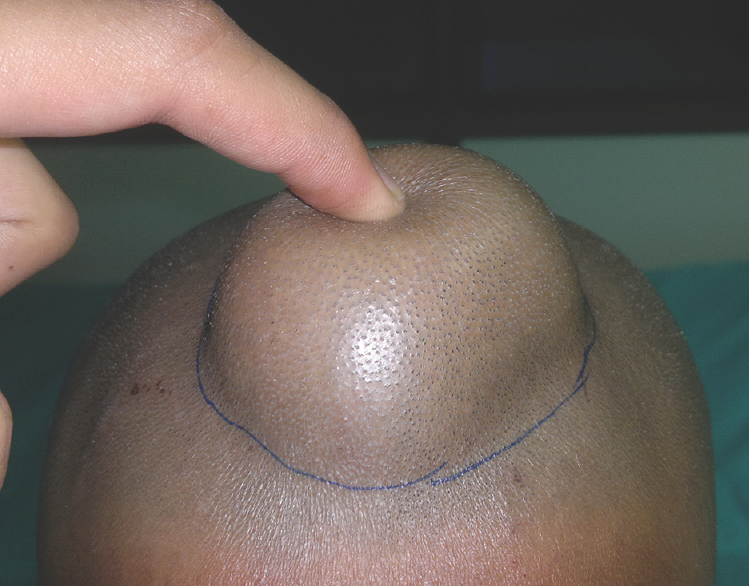 Photograph of one male patient showing the dermoid cyst