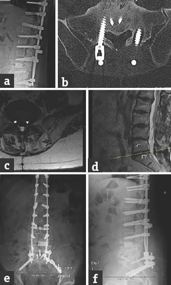 (a) Lateral radiograph and (b) axial computed tomography of a patient with a previous long-segment lumbosacral fusion with pseudoarthrosis as evidenced by the left S1 screw lucency. (c) Axial and (d) sagittal magnetic resonance imaging showing residual foraminal stenosis at L5-S1. (e) Anteroposterior and (f) lateral postoperative radiograph after minimally invasive extension of the fusion to the pelvis