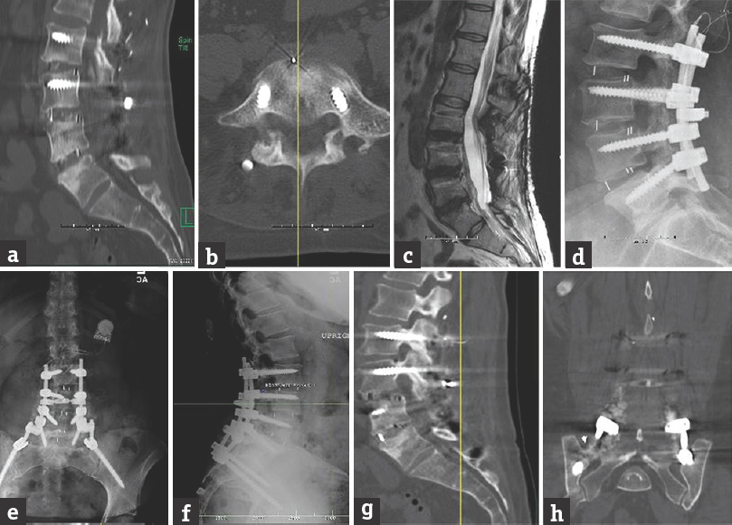 Preoperative (a and b) computed tomography scan and (c and d) magnetic resonance imaging of a patient with a previous lumbosacral fusion with evidence of pseudoarthrosis. (e) Anteroposterior and (f) lateral postoperative radiograph after minimally invasive extension of the fusion to the pelvis. Six months’ postoperative (g) sagittal and (h) coronal computed tomography scan showing evidence of fusion from the pelvis to L5