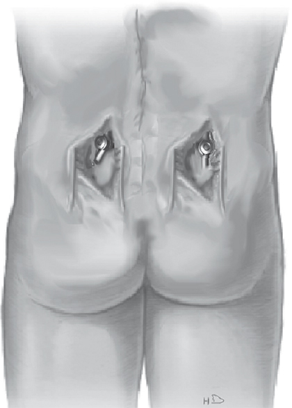 An illustration of bilateral paramedian incisions depicting exposure of only the lower end of the long segment fusion construct to facilitate sacroiliac fixation