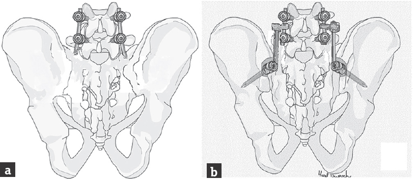 (a) The previous instrumentation extending down to S1 is noted. (b) The side connectors connect a rod, which is then secured to the two iliac screws placed