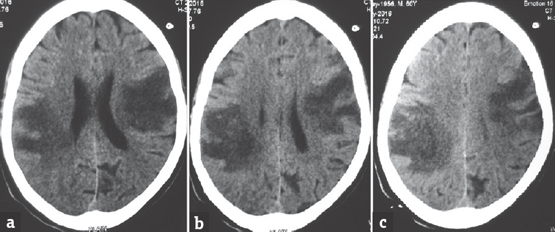 Axial noncontrast computed tomography scan sections showing bihemispheric hypodensities in frontoparietal regions