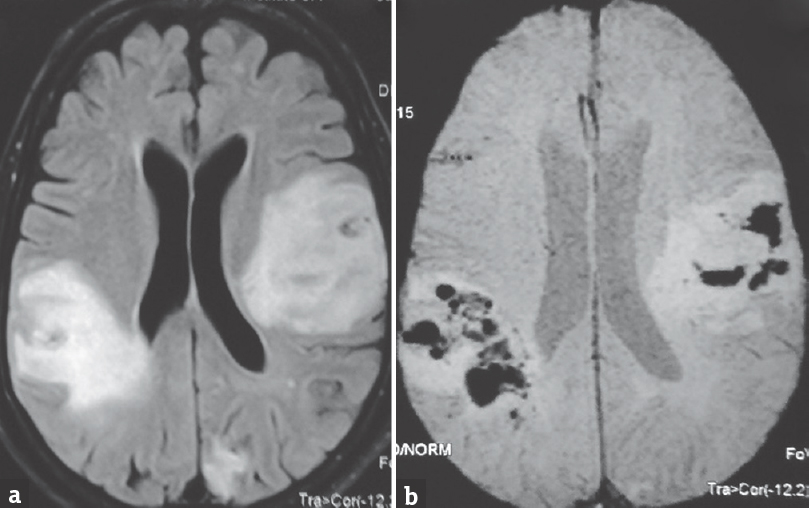 Axial magnetic resonance imaging showing bilateral hyperintensities suggestive of infarct in (a) fluid attenuation inversion recovery sequences with evidence of hemorrhagic transformation in (b) gradient echocardiography imaging sequences