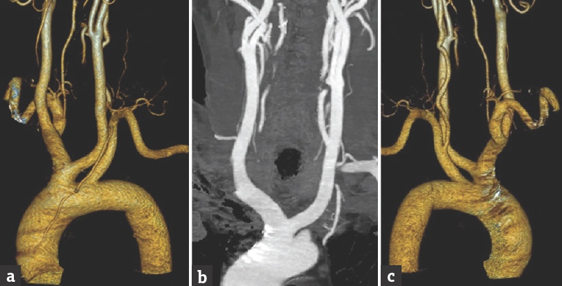 Computed tomography angiography images with three-dimensional reconstruction (a) anterior view and (c) posterior view showing common origin of the left common carotid artery and innominate artery from the aortic arch (b) coronal computed tomography image with contrast showing both common carotid artery resembling horns of a bull