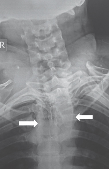 X-ray image showing misalignment in the thoracic spine