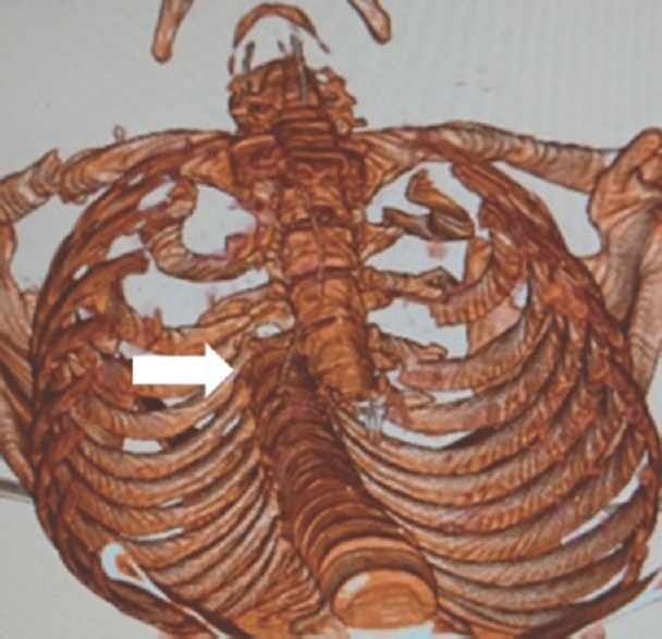 Computerized tomography thorax showing complete lateral spondyloptosis of the thoracic vertebrae