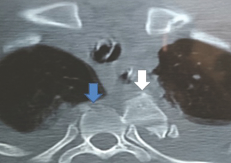 Axial computerized tomography scan showing two adjacent vertebrae lying parallel to one another