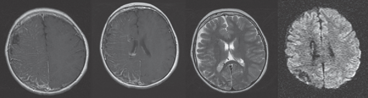 Cranial magnetic resonance imaging showing leptomeningeal contrast enhancement compatible with leptomeningeal angiomas. Diffusion weighted imaging showing normal appearance