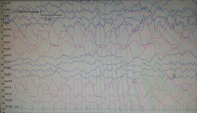 Electroencephalography (double banana 1) recorded on the 3rd day of admission showing polymorphic delta slow waves in the right hemisphere (concurrently neurological examination revealed 3-/5 motor paralysis in the left upper and lower limbs)