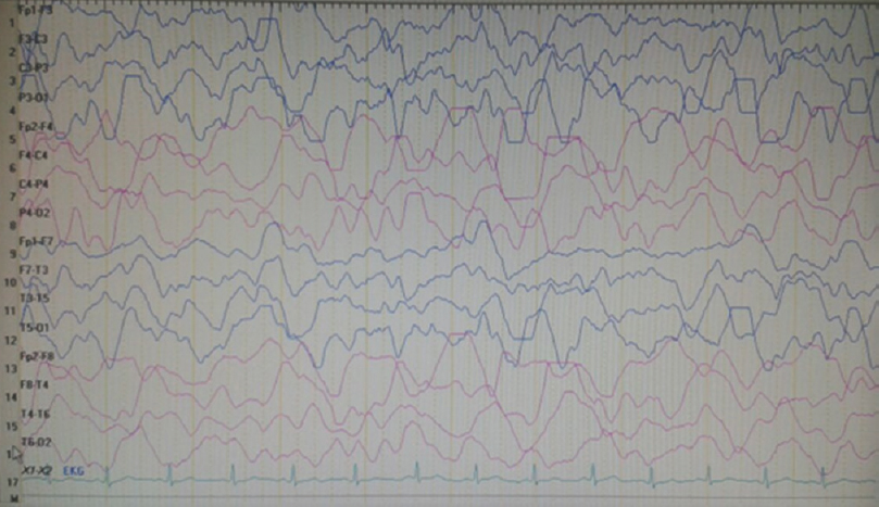 Electroencephalography recorded on the 5th day of admission showing evolution of delta waves on the contralateral hemisphere (left hemisphere) and a mild increment in the background delta activity of the right hemisphere