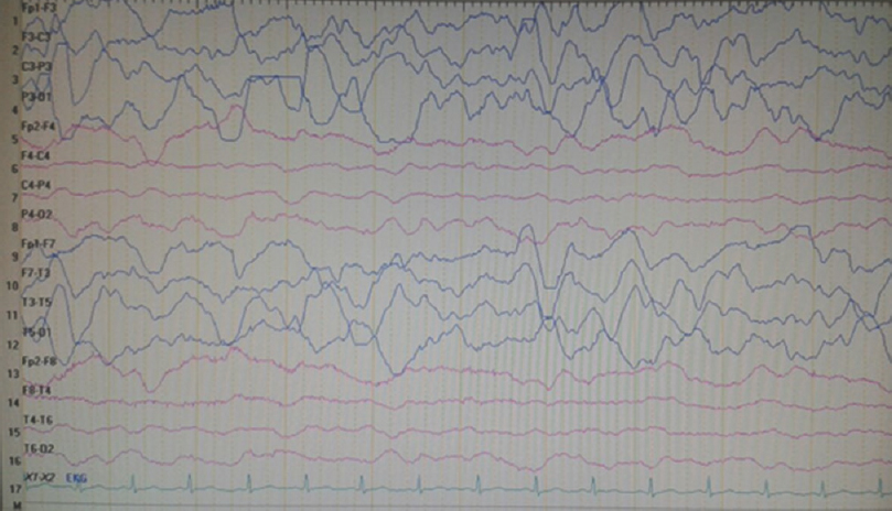 Electroencephalography, on the 7th day of admission, showing right hemisphere voltage attenuation and resolution of delta waves, whereas contralateral (left hemisphere) high-amplitude delta waves had been the prominent background activity