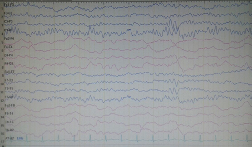 Electroencephalography recorded on the 20th day of admission showing near-total recovery of the background activity (concurrently motor strength examinations showed normal muscle strength and other neurological evaluations were within normal ranges)