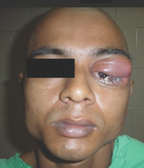 Clinical photograph showing left periorbital swelling