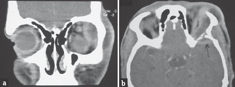 Contrast enhancing computed tomography scan brain; coronal view (a), showing left lateral orbital mass displacing eyeball medially and downward and axial view (b) showing erosion of lateral orbital wall with extension of lesion in to cranial cavity