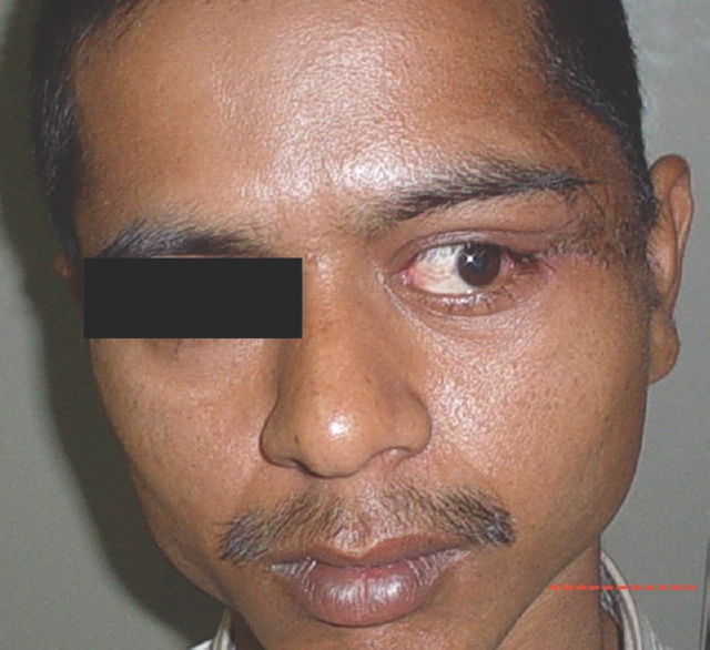 Postoperative clinical photograph showing complete disappearance of left orbital swelling with normal movement of left lateral rectus