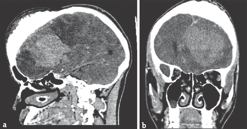 (a and b) Contrast-enhanced computed tomography head showing contrast-enhancing unilateral dural-based extra-axial frontal space-occupying lesion suggestive of meningioma