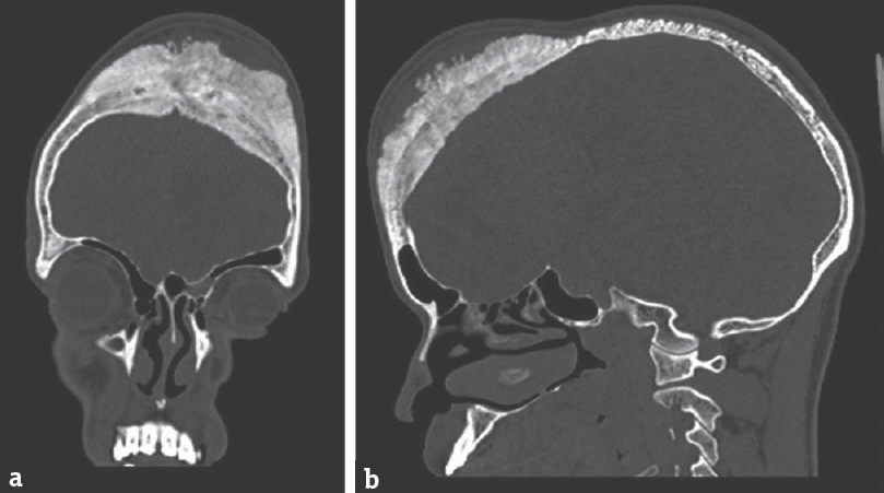 (a and b) Computed tomography bone cuts showing extensive bilateral calvarial hyperostosis