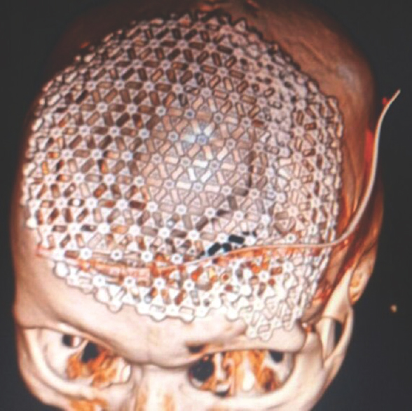 Postoperative computed tomography (three-dimensional reconstruction) showing repair of cranial defect using titanium mesh