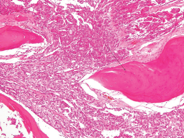 Histopathology examination showing sheets and whorls of tumor cells (meningioma) infiltrating bone (arrow)