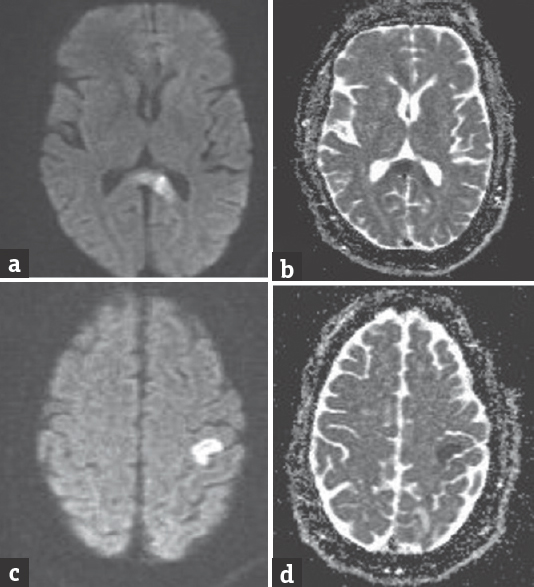 (a and b) Diffusion-weighted imaging and apparent diffusion coefficient of the first magnetic resonance imaging brain showing splenial infarct. (c and d) Diffusion-weighted imaging and apparent diffusion coefficient of the second magnetic resonance imaging brain showing infarct at the left precentral gyrus