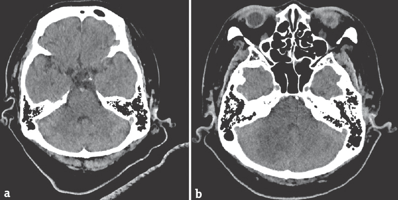 Axial view of noncontrasted computed tomography brain. The basilar artery is hyperdense (a). There are hypodensities seen at brainstem and bilateral cerebellum on repeated computed tomography brain at 24 h (b)