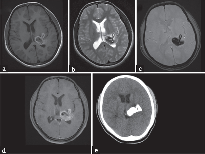 Magnetic resonance imaging brain (a-d) shows a large lobulated lesion involving left thalamus with beaklike protrusion in the adjacent brain parenchyma. The periphery of the lesion appears hyperintense on T1-weighted image (a) and hypointense on T2-weighted and gradient recalled echo images (b and c) with minimal postcontrast enhancement (d). The center of the lesion shows cerebrospinal fluid-like signal intensity on all sequences. Non-contrast CT brain (e) shows dense calcification in the lesion