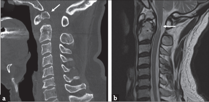 (a) Sagittal computed tomography of the cervical spine shows a separate odontoid process (arrow) from the body of C2. (b) Sagittal T2-weighted cervical magnetic resonance imaging reveals narrowing and hyperintensity (arrow) of the spinal cord at C2 level