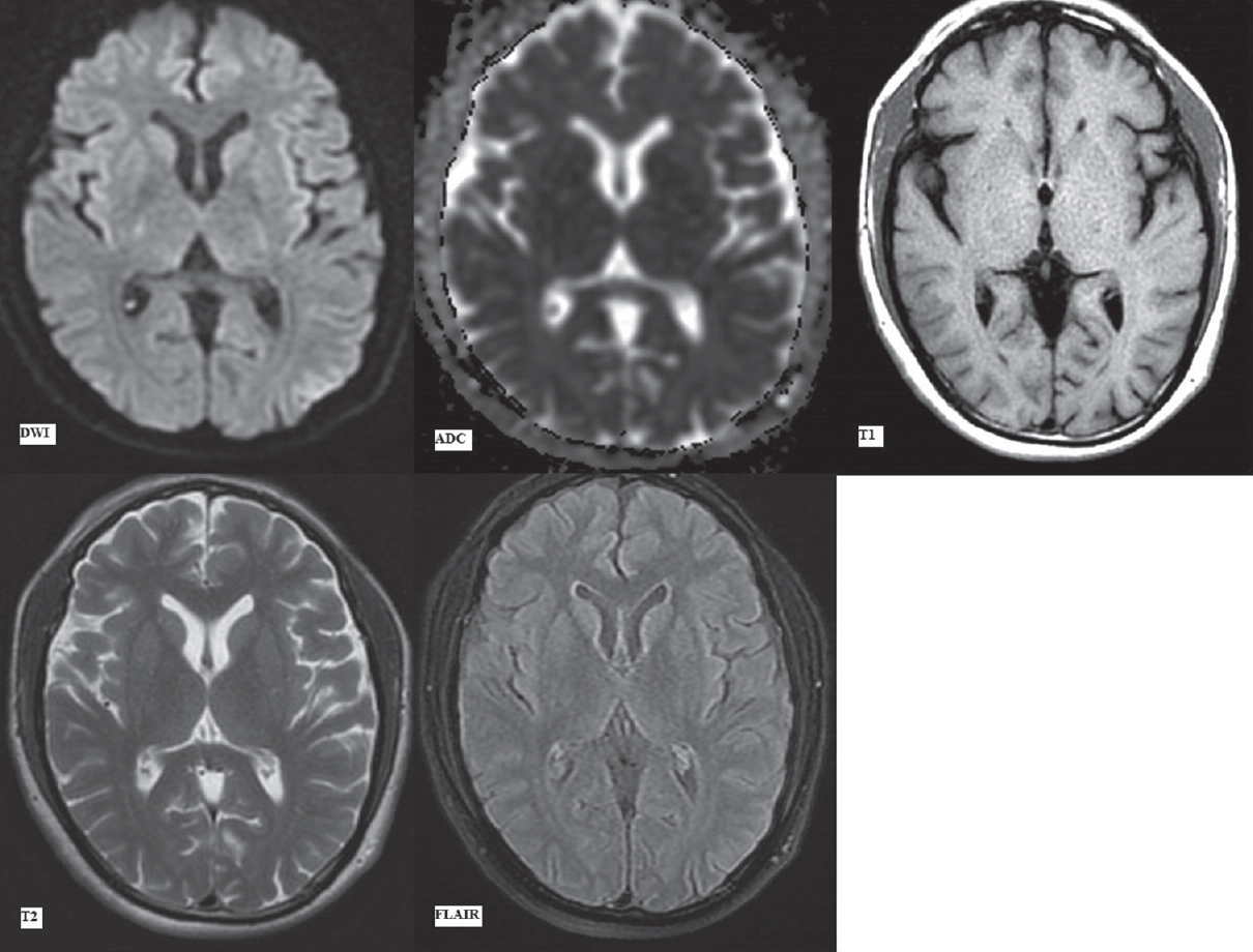 First magnetic resonance imaging at presentation (day 1). Diffusion-weighted imaging with apparent diffusion coefficient map, T1-weighted, T2-weighted and fluid attenuation inversion recovery images (as labeled) at the level of pons showing no signal alteration