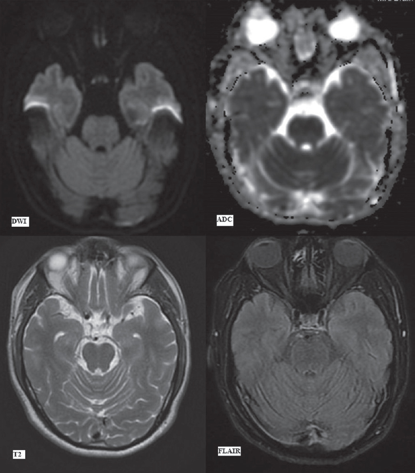 First magnetic resonance imaging at presentation (day 1). Diffusion-weighted imaging, apparent diffusion coefficient map, T2-weighted and fluid attenuation inversion recovery images (as labelled) at the level of basal ganglia showing no signal alteration