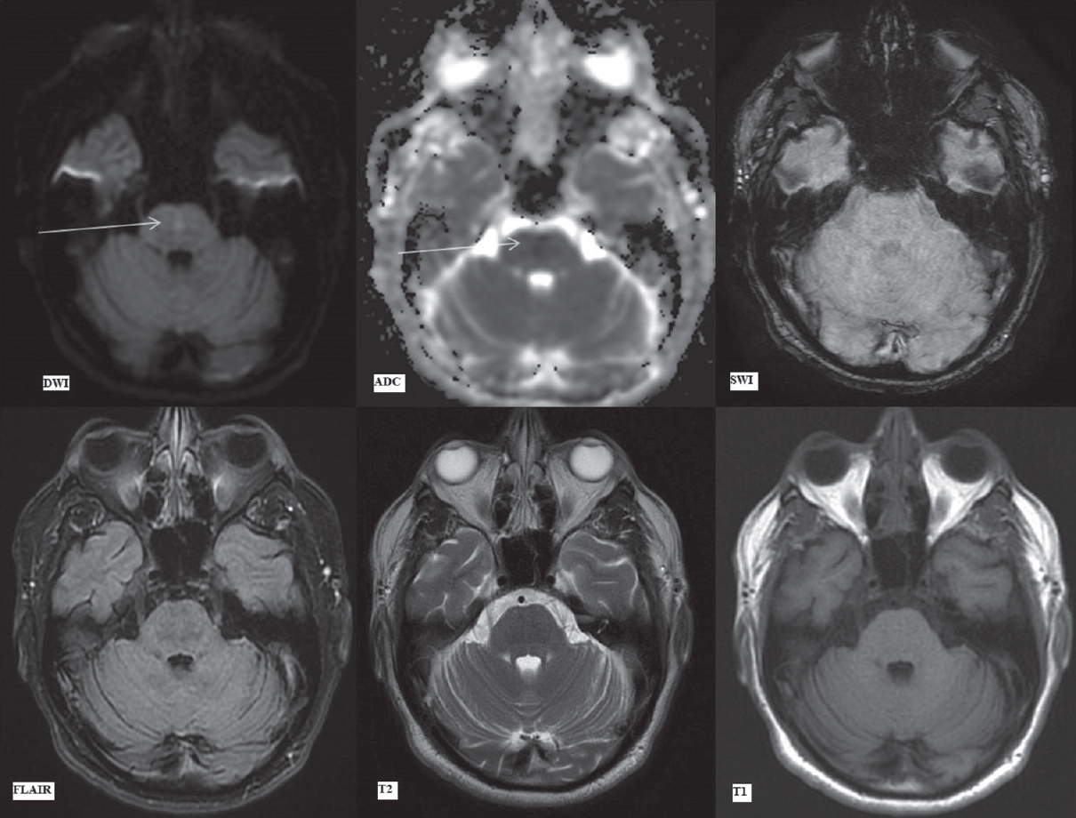 Magnetic resonance imaging brain findings on day 7. Diffusion-weighted imaging, apparent diffusion coefficient map, susceptibility-weighted imaging, fluid attenuation inversion recovery, T2-weighted and T1-weighted images (as labeled) at the level of pons. Arrows showing focal hyperintensity in the central pons on diffusion-weighted imaging with corresponding signal drop on apparent diffusion coefficient suggestive of restricted diffusion. susceptibility-weighted imaging, fluid attenuation inversion recovery, T2-weighted and T1-weighted images show no signal alteration