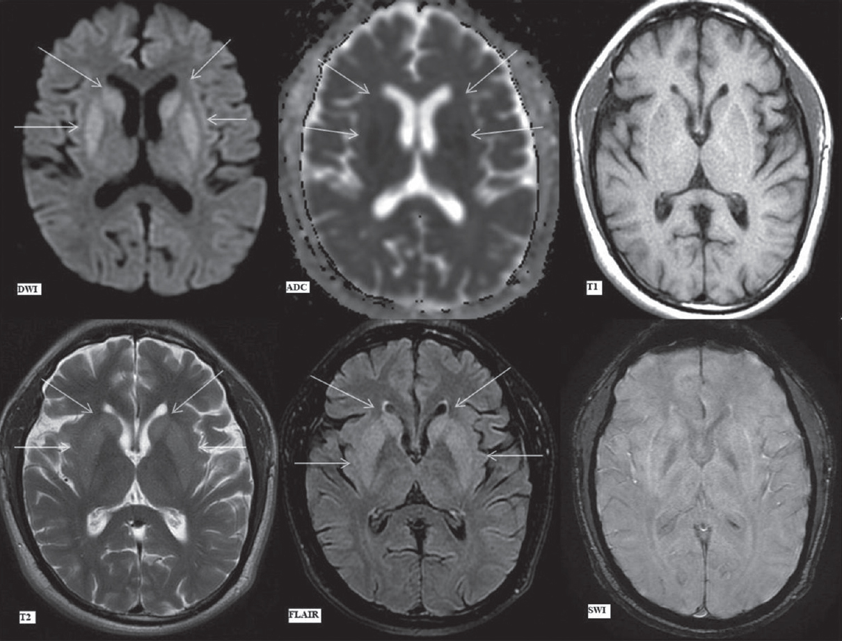 Magnetic resonance imaging brain findings on day 7. Diffusion-weighted imaging, apparent diffusion coefficient map, T1-weighted, T2-weighted, fluid attenuation inversion recovery and susceptibility-weighted imaging images (as labeled) at the level of basal ganglia. Arrows showing hyperintense signal on diffusion-weighted imaging and subsequent apparent diffusion coefficient image showing corresponding signal drop in bilateral caudate nuclei (upper arrows) and putamina (lower arrows), suggestive of restricted diffusion. Hyperintense signal in these areas (upper and lower arrows) on T2-weighted image and fluid attenuation inversion recovery image. No signal alteration on T1-weighted image and susceptibility-weighted imaging image