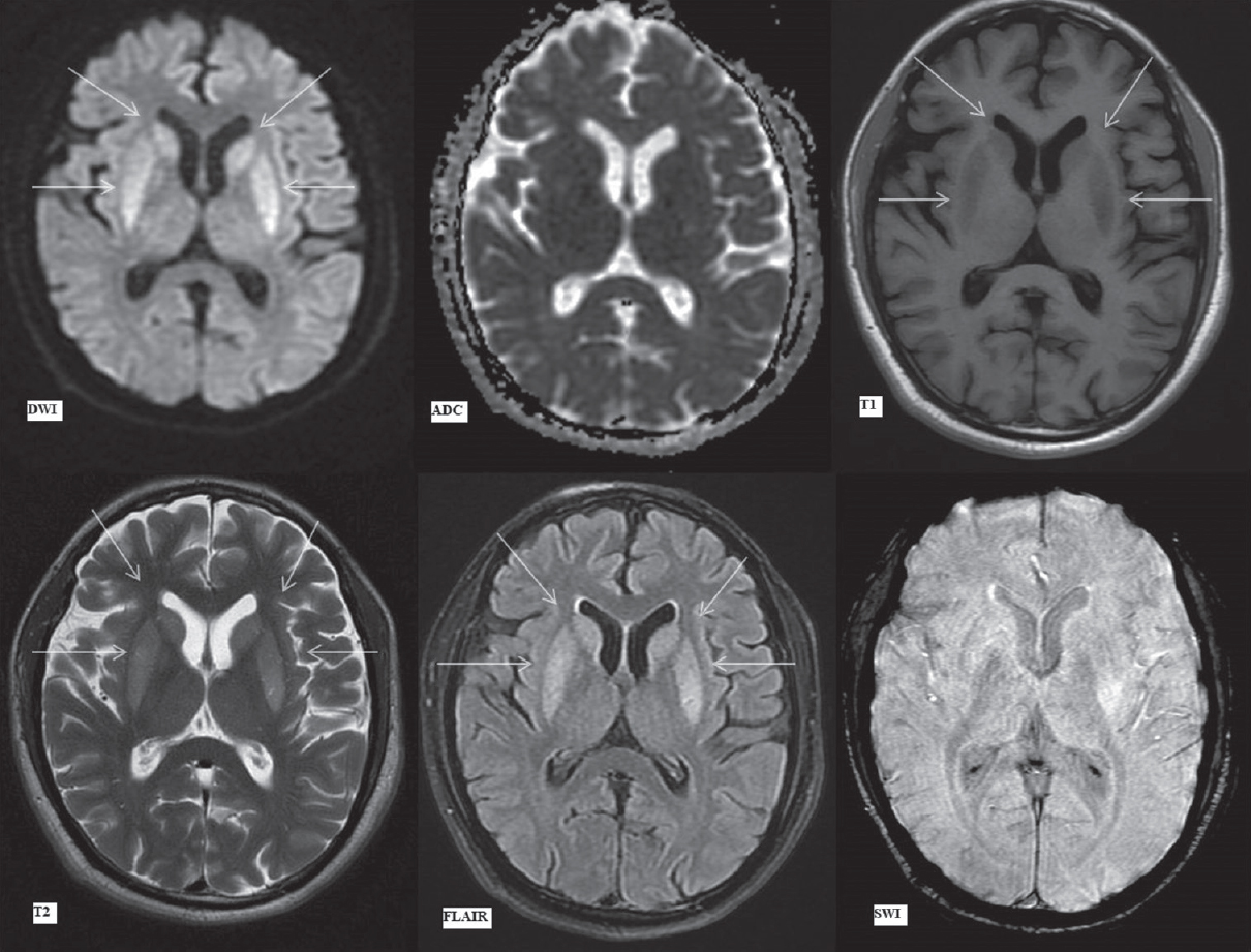 Magnetic resonance imaging brain findings on day 19. Diffusion-weighted imaging, apparent diffusion coefficient, T1-weighted, T2-weighted, fluid attenuation inversion recovery and susceptibility-weighted imaging images (as labeled) at the level of basal ganglia. Hyperintense signal on diffusion-weighted imaging in bilateral caudate nuclei (upper arrows) and putamina (lower arrows) without any signal drop on apparent diffusion coefficient. Subsequent images show symmetrical hypointense signal on T1-weighted and hyperintense signal on T2 and fluid attenuation inversion recovery images in bilateral caudate nuclei (upper arrows) and putamina (lower arrows)